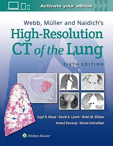 Webb, MÃ¼ller and Naidich's High-Resolution CT of the Lung