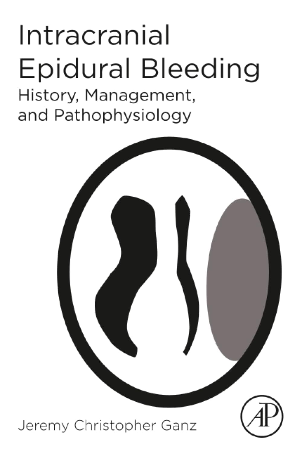 Intracranial Epidural Bleeding: History, Management, and Pathophysiology