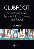 Clubfoot: A Comprehensive Approach (Past, Present, and Future)